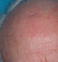 skin image after treatment with Klisyri