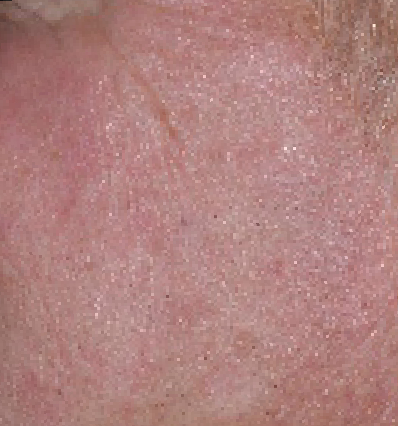 skin image after treatment with Klisyri